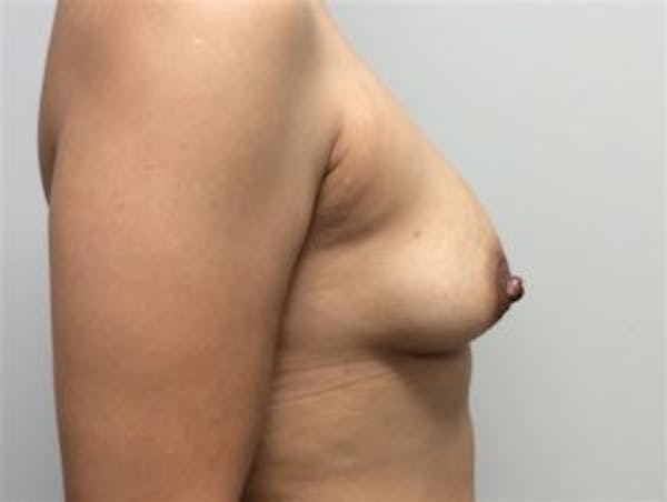 Breast Augmentation Before & After Gallery - Patient 4594819 - Image 3
