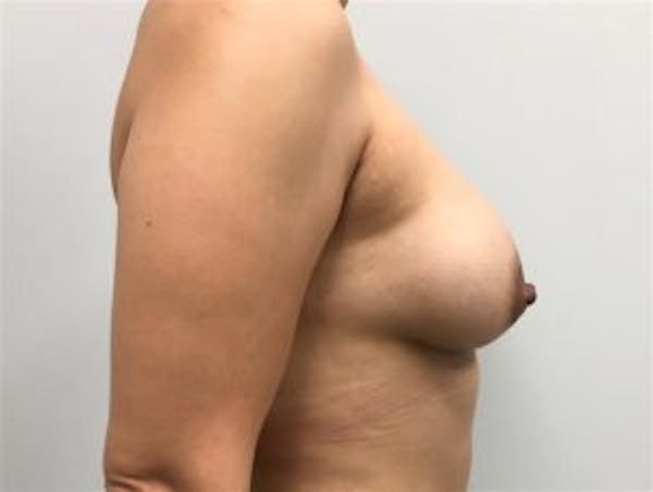 Breast Augmentation Before & After Gallery - Patient 4594819 - Image 4
