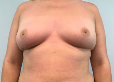 Breast Augmentation Before & After Gallery - Patient 4594820 - Image 1