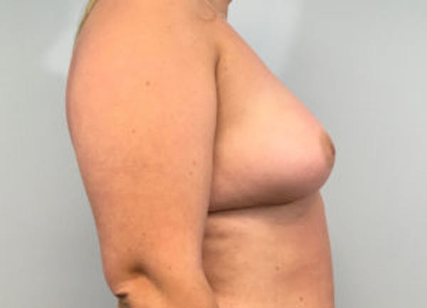 Breast Augmentation Before & After Gallery - Patient 4594820 - Image 3