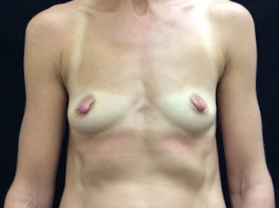 Breast Augmentation Before & After Gallery - Patient 4594822 - Image 1