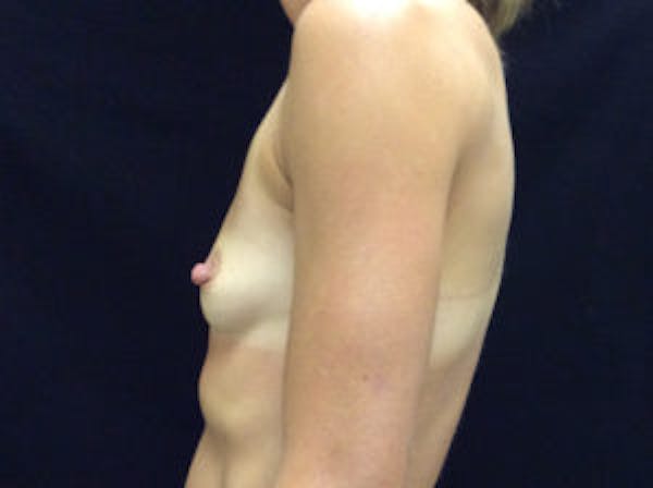 Breast Augmentation Before & After Gallery - Patient 4594822 - Image 3
