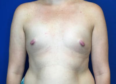 Breast Augmentation Before & After Gallery - Patient 4594826 - Image 1