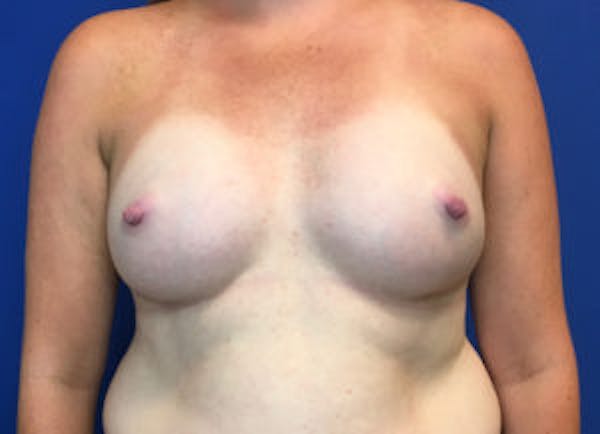 Breast Augmentation Before & After Gallery - Patient 4594826 - Image 2