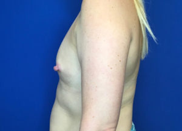 Breast Augmentation Before & After Gallery - Patient 4594826 - Image 3
