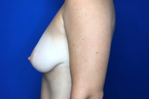 Breast Augmentation Before & After Gallery - Patient 4594827 - Image 3