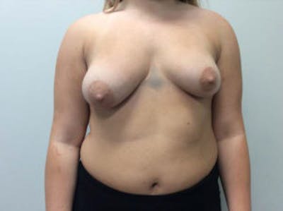 Breast Augmentation Before & After Gallery - Patient 4594828 - Image 1