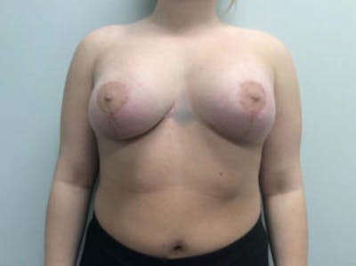 Breast Augmentation Before & After Gallery - Patient 4594828 - Image 2