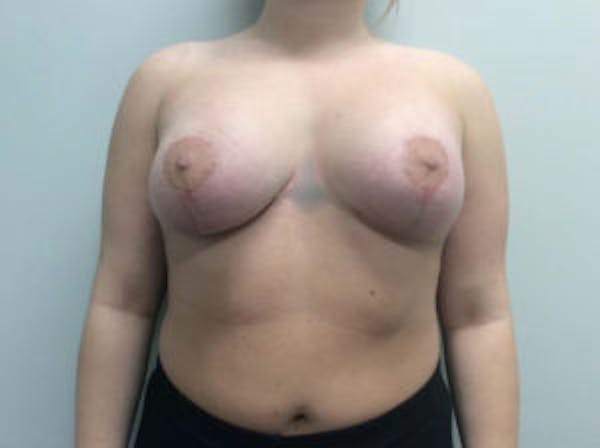 Breast Augmentation Before & After Gallery - Patient 4594828 - Image 2