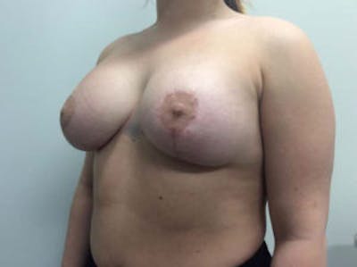Breast Augmentation Before & After Gallery - Patient 4594828 - Image 4