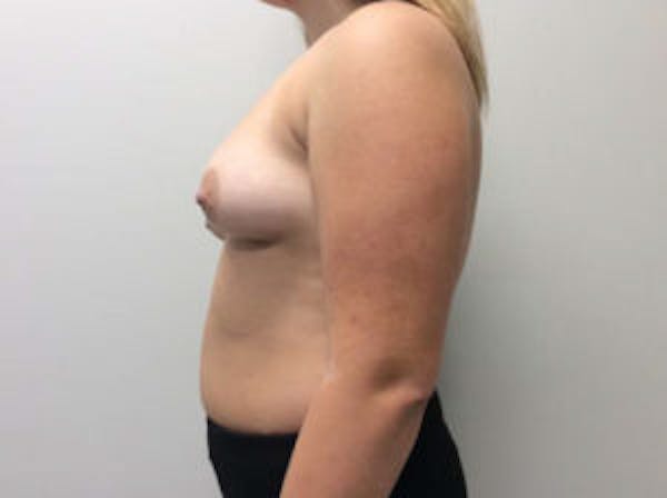 Breast Augmentation Before & After Gallery - Patient 4594828 - Image 5