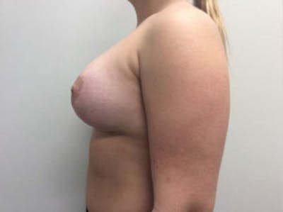 Breast Augmentation Before & After Gallery - Patient 4594828 - Image 6