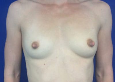 Breast Augmentation Gallery - Patient 4594830 - Image 1