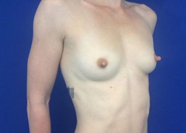 Breast Augmentation Before & After Gallery - Patient 4594830 - Image 3