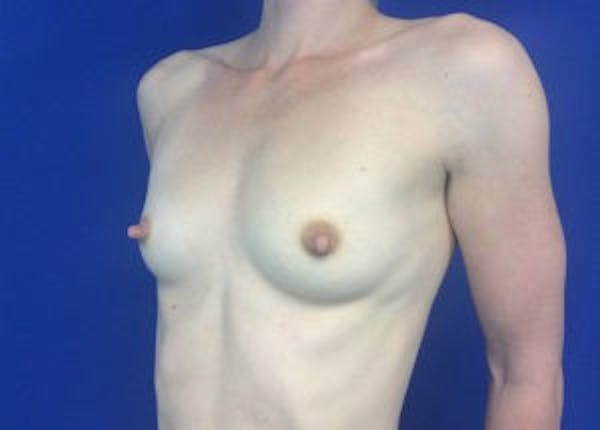 Breast Augmentation Before & After Gallery - Patient 4594830 - Image 5