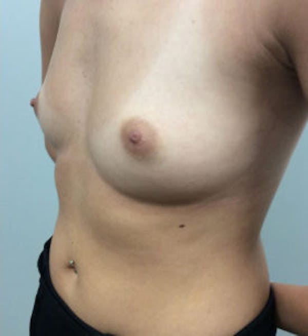 Breast Augmentation Before & After Gallery - Patient 4594834 - Image 3