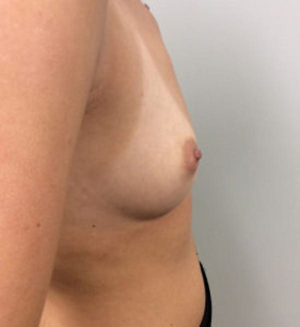Breast Augmentation Before & After Gallery - Patient 4594834 - Image 5