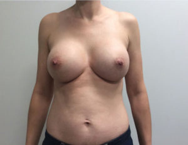 Breast Augmentation Before & After Gallery - Patient 4594835 - Image 2