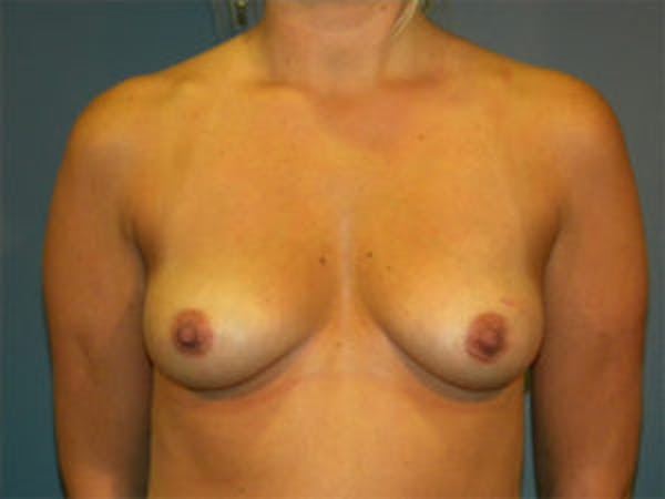 Mastopexy Before & After Gallery - Patient 4709855 - Image 1