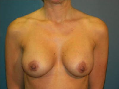 Mastopexy Before & After Gallery - Patient 4709855 - Image 2
