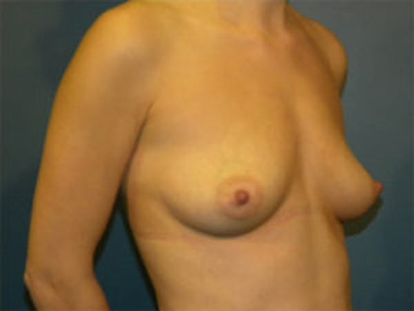 Mastopexy Before & After Gallery - Patient 4709856 - Image 1