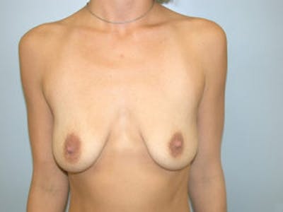 Mastopexy Before & After Gallery - Patient 4709857 - Image 1