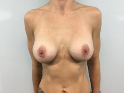 Mastopexy Before & After Gallery - Patient 4709857 - Image 2