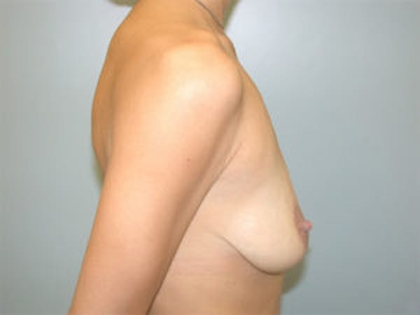Mastopexy Before & After Gallery - Patient 4709857 - Image 3
