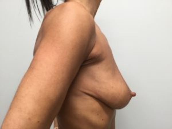 Mastopexy Before & After Gallery - Patient 4709858 - Image 3
