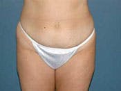 Tummy Tuck