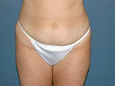 Tummy Tuck (Abdominoplasty) Before & After Gallery - Patient 4594886 - Image 1
