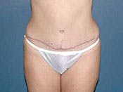 Tummy Tuck