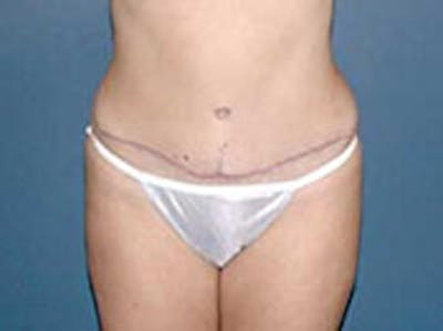 Tummy Tuck (Abdominoplasty) Before & After Gallery - Patient 4594886 - Image 2