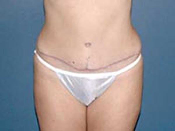 Tummy Tuck (Abdominoplasty) Before & After Gallery - Patient 4594886 - Image 2