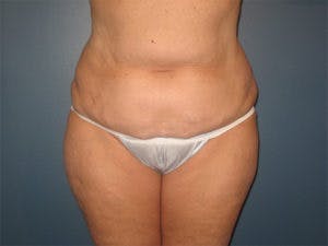 Tummy Tuck