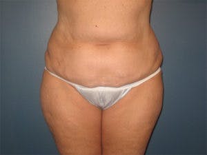 Tummy Tuck