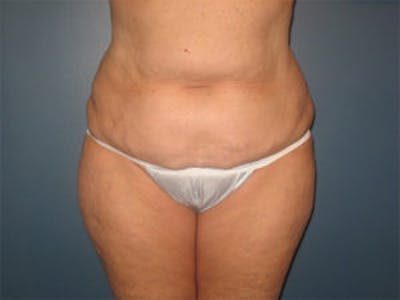Tummy Tuck (Abdominoplasty) Before & After Gallery - Patient 4594887 - Image 1