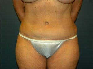 Tummy Tuck