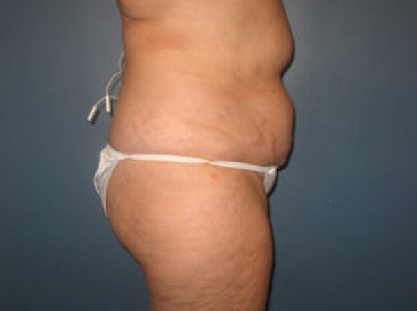Tummy Tuck (Abdominoplasty) Before & After Gallery - Patient 4594887 - Image 3