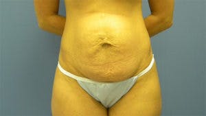 Tummy Tuck