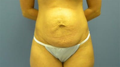 Tummy Tuck (Abdominoplasty) Before & After Gallery - Patient 4594888 - Image 1