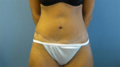 Tummy Tuck (Abdominoplasty) Before & After Gallery - Patient 4594888 - Image 2