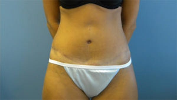 Tummy Tuck (Abdominoplasty) Before & After Gallery - Patient 4594888 - Image 2