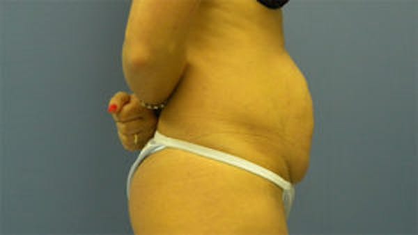 Tummy Tuck (Abdominoplasty) Before & After Gallery - Patient 4594888 - Image 3