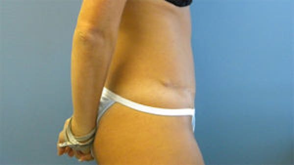 Tummy Tuck (Abdominoplasty) Before & After Gallery - Patient 4594888 - Image 4