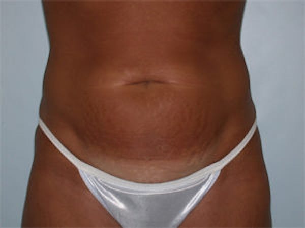Tummy Tuck (Abdominoplasty) Before & After Gallery - Patient 4594889 - Image 1