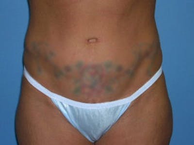 Tummy Tuck (Abdominoplasty) Gallery - Patient 4594889 - Image 2