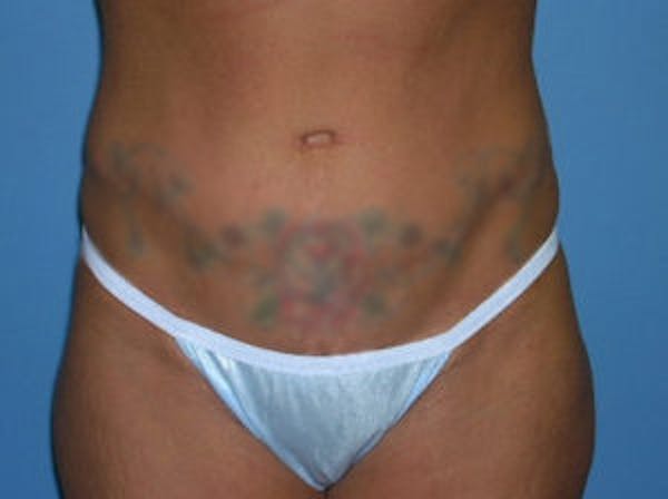 Tummy Tuck (Abdominoplasty) Gallery - Patient 4594889 - Image 2
