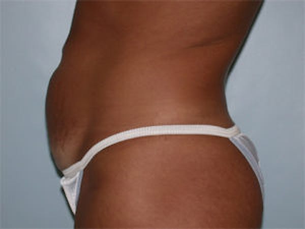 Tummy Tuck (Abdominoplasty) Before & After Gallery - Patient 4594889 - Image 3