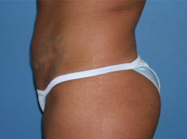 Tummy Tuck (Abdominoplasty) Before & After Gallery - Patient 4594889 - Image 4